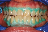 3. Put the protective gel on the gums