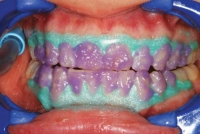 4. Put the bleaching gel on the teeth