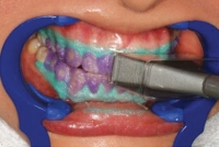 5. Article bleached shedding light on the handpiece for