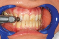 2. Cleaning the teeth with brush and pumice