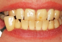 1. Determine the original color of the teeth and taking photography