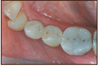 ترمیم کامپازیت دندان مولر با تماس دندان مقابل بر روی ترمیم
